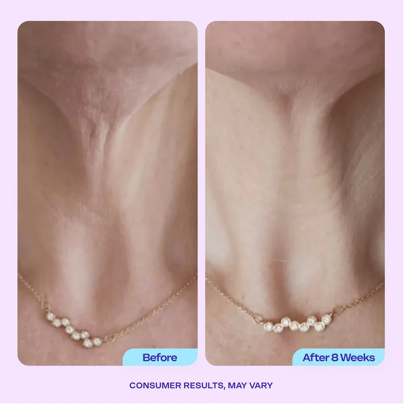 2. 6 Weeks Is All It Takes To See Your Neck Transform