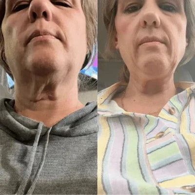 4. A Neck Solution For Women Who Lost The Weight But Kept The Skin