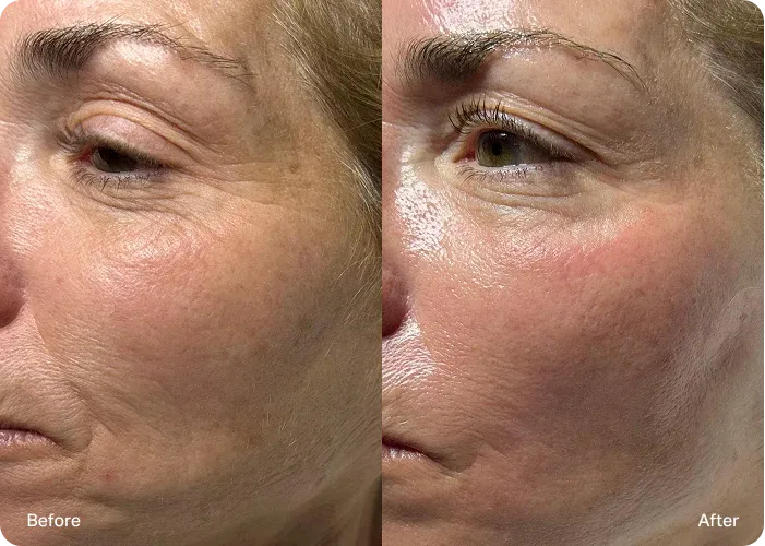 Pink Threads Deliver Collagen Instantly