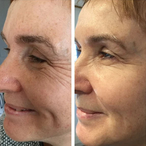 30 Peptides That Mimic Botox Injections — Without the Needles or Frozen Face